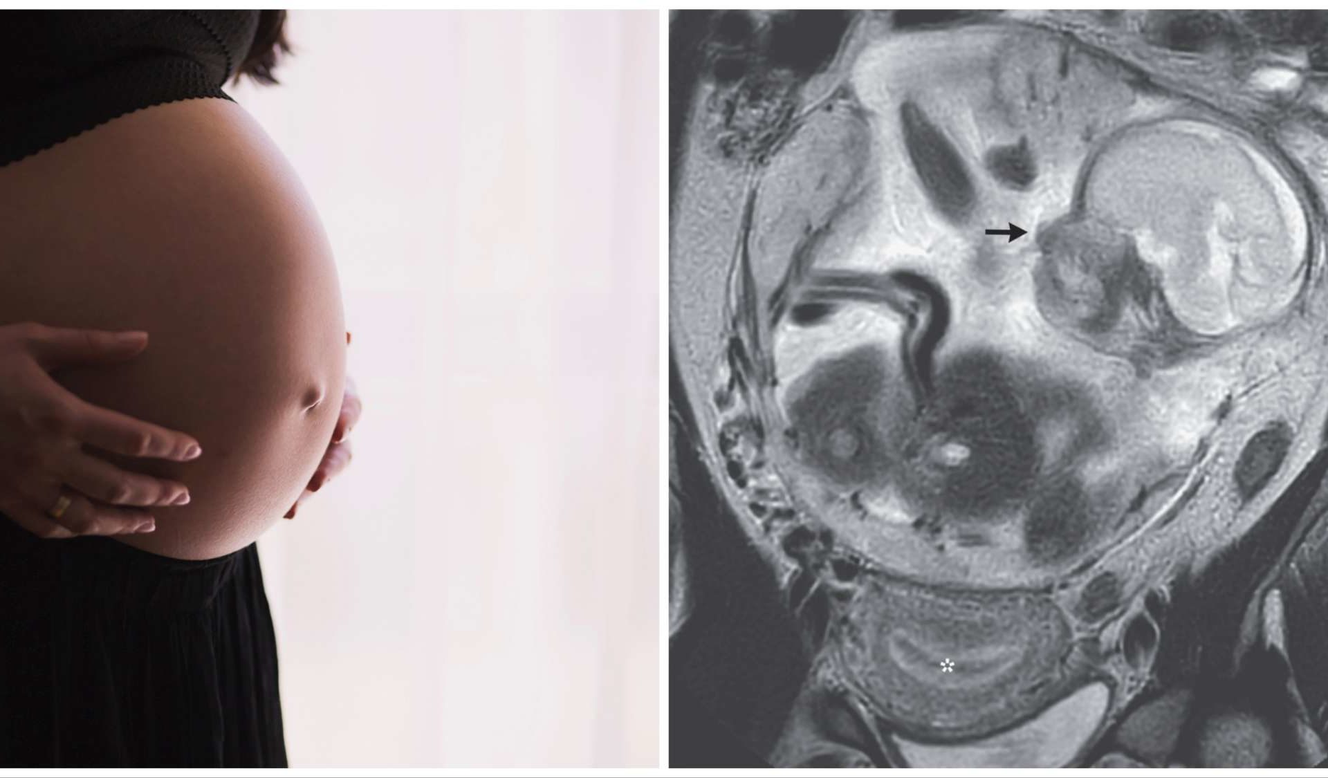 In ospedale per mal di pancia, era incinta: ma il feto cresceva nell'intestino