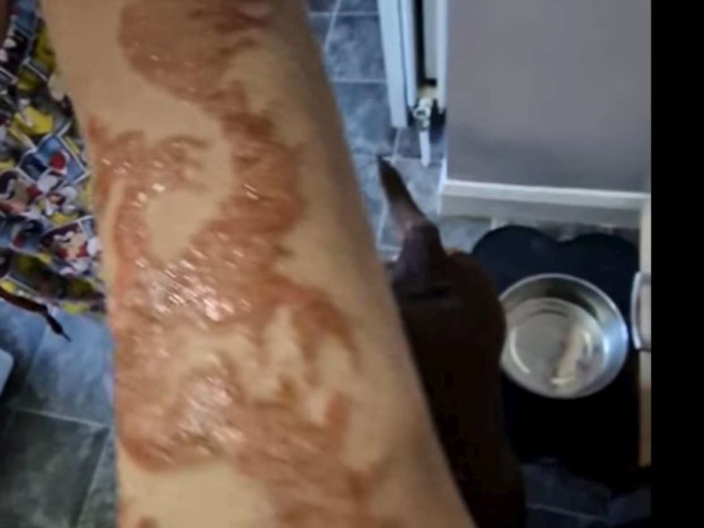 Bimbo fa tatuaggio all'henné in vacanza: braccio ustionato