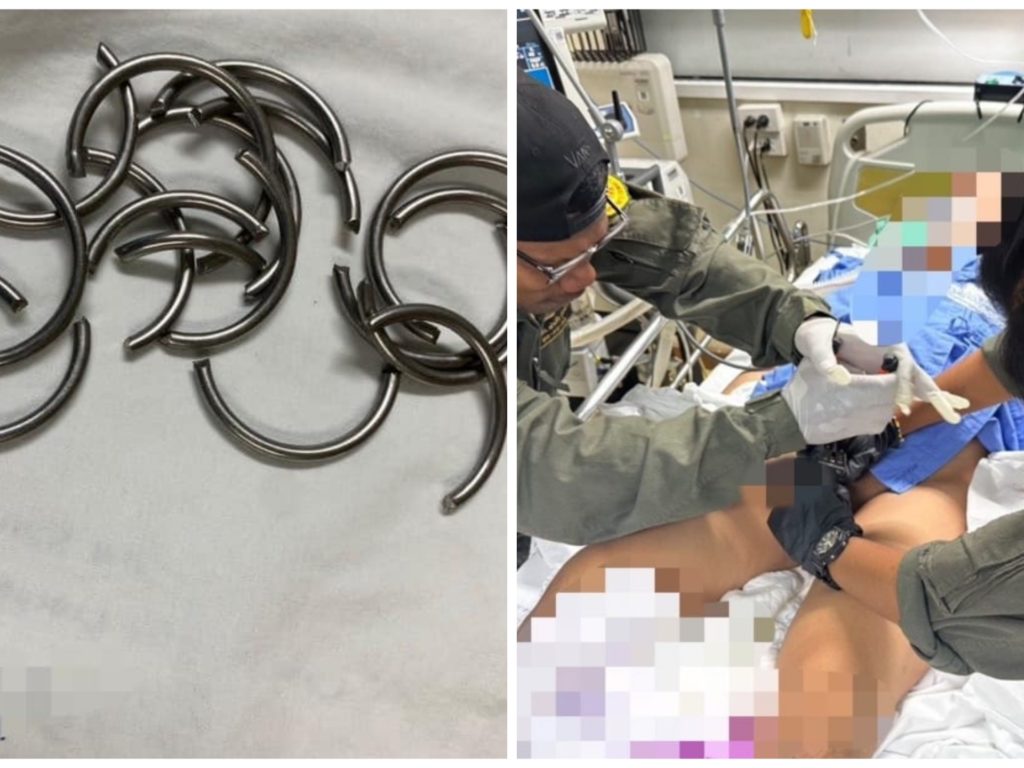 Si incastra 11 anelli penici e va in ospedale: medico lo salva col tronchese