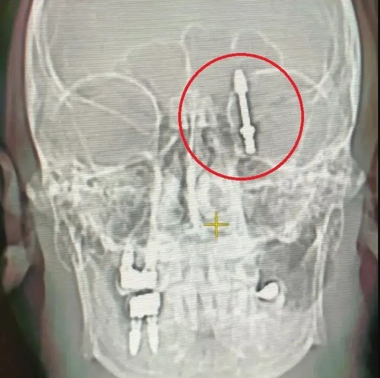 Dentista sbaglia e stringe troppo l'impianto: entra con la vite nel cranio